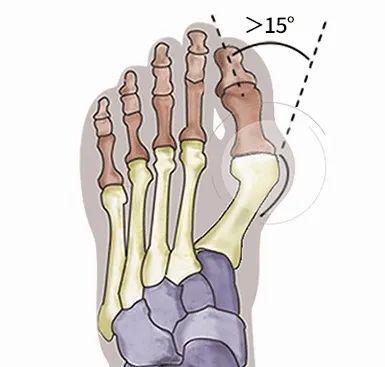 大脚趾凸出也是病by体育！快来自我评估 健康总动员(图1)